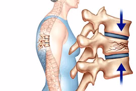 Các phương pháp điều trị xẹp đốt sống do loãng xương