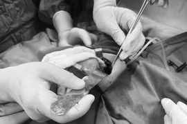 Cứu sống bệnh nhi bị thoát vị hoành bẩm sinh