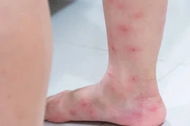 Dấu hiệu lạ trên da cảnh báo bệnh tiểu đường, chớ chủ quan