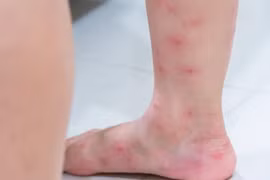 Dấu hiệu lạ trên da cảnh báo bệnh tiểu đường, chớ chủ quan