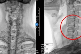 Hỏng ba đốt sống cổ do... cúi đầu dùng điện thoại 8 giờ/ ngày