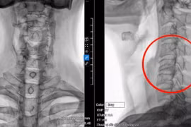 Hỏng ba đốt sống cổ do... cúi đầu dùng điện thoại 8 giờ/ ngày