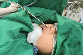 Hiếm gặp, bé trai 4 tuổi có răng mọc ở mũi 