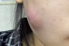 Nữ bệnh nhân suýt hoại tử vùng mặt do... tự nặn mụn ở nhà