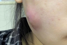Nữ bệnh nhân suýt hoại tử vùng mặt do... tự nặn mụn ở nhà