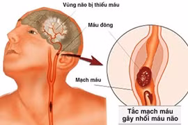 Biện pháp phòng ngừa bệnh thiểu năng tuần hoàn não gây tai biến