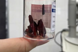 Mảnh gỗ dài nằm trong hốc mắt nam thanh niên suốt 1 tháng