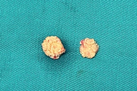 Người đàn ông sưng đau vùng hàm không ngờ sỏi tuyến nước bọt