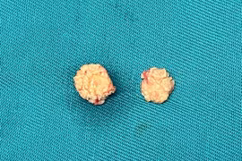 Người đàn ông sưng đau vùng hàm không ngờ sỏi tuyến nước bọt