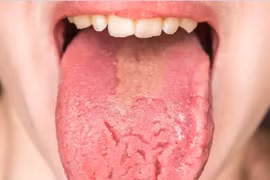 Dấu hiệu khác lạ ở lưỡi cảnh báo những bệnh nguy hiểm