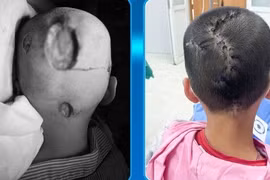 Bé 7 tuổi hoại tử da đầu do nấm bội nhiễm, cách phòng tránh