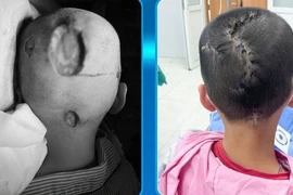 Bé 7 tuổi hoại tử da đầu do nấm bội nhiễm, cách phòng tránh