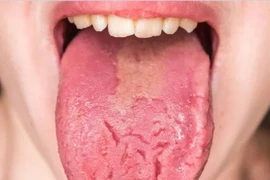 Dấu hiệu khác lạ ở lưỡi cảnh báo những bệnh nguy hiểm