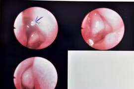 Bé gái 13 tháng tuổi bị vắt chui vào hốc mũi 