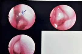 Bé gái 13 tháng tuổi bị vắt chui vào hốc mũi 