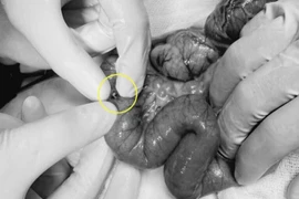 Cắt bỏ đoạn ruột 15 cm cứu bệnh nhi nuốt 20 viên bi nam châm