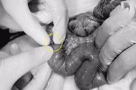 Cắt bỏ đoạn ruột 15 cm cứu bệnh nhi nuốt 20 viên bi nam châm