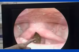 Phát hiện đỉa dài 6 cm sống trong cổ họng người đàn ông