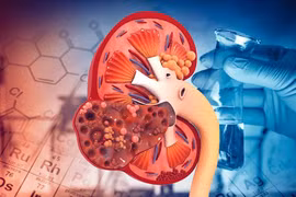 Thói quen xấu hàng ngày dễ dẫn đến suy thận