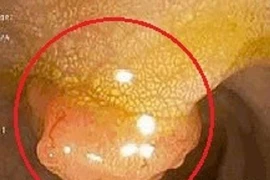 Người phụ nữ 34 tuổi cùng lúc mắc hai bệnh ung thư