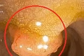 Người phụ nữ 34 tuổi cùng lúc mắc hai bệnh ung thư