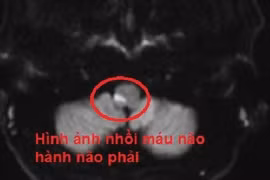 Tưởng đau đầu, chóng mặt vì say rượu ai ngờ đột quỵ não