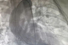 Đang hồi sức tích cực do chấn thương sọ não thì “vỡ tim” 