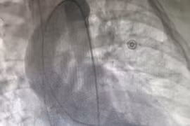 Đang hồi sức tích cực do chấn thương sọ não thì “vỡ tim” 