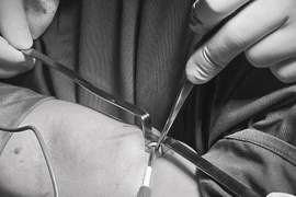 Que tránh thai đi lạc vào cơ cánh tay có thể gây liệt