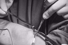 Que tránh thai đi lạc vào cơ cánh tay có thể gây liệt