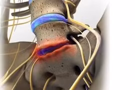 Chuyên gia mách dấu hiệu bệnh thoái hóa đĩa đệm cột sống thắt lưng