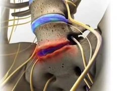 Chuyên gia mách dấu hiệu bệnh thoái hóa đĩa đệm cột sống thắt lưng