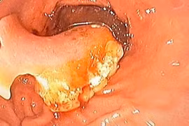 Gắp thành công hàm răng giả trong dạ dày nữ bệnh nhân