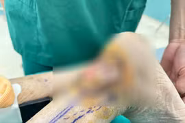 Tái tạo vết thương lở loét cả năm sau nhiều lần phẫu thuật do chó cắn