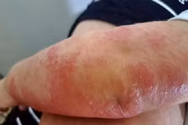 Cách chăm sóc cho trẻ bị viêm da cơ địa