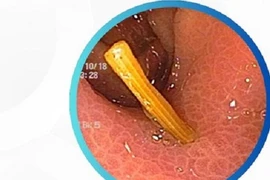 Nhiều trường hợp nuốt phải tăm tre nguy hiểm