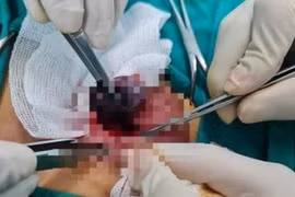 Xoắn tinh hoàn, giờ vàng xử trí tránh biến chứng vô sinh