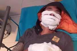 Điện thoại sạc qua đêm phát nổ khiến hai người bỏng nặng