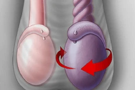 Thanh niên 16 tuổi bị xoắn tinh hoàn hoại tử