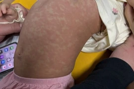 Bé gái 4 tuổi ở Hà Nội tử vong do sởi