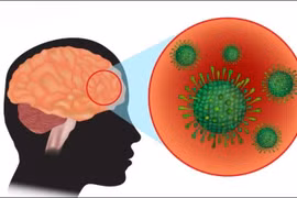 Bé 6 tháng tuổi mắc não mô cầu, dấu hiệu cảnh báo bệnh