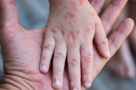 Ai có nguy cơ cao mắc bệnh sởi, phòng tránh thế nào?