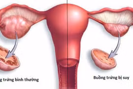 Suy buồng trứng sớm, dấu hiệu cảnh báo cần chú ý