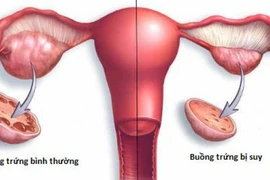 Suy buồng trứng sớm, dấu hiệu cảnh báo cần chú ý