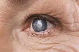 Biến chứng mắt ở người bệnh đái tháo đường dễ gây mù lòa