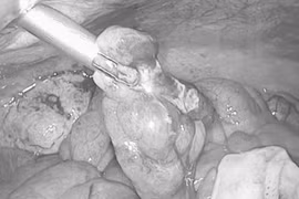 Tự chữa đau bụng tại nhà, nam sinh suýt gặp nguy hiểm 