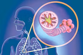 Thuyên tắc động mạch phổi, “sát thủ” ẩn mình nên cẩn trọng