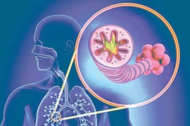 Thuyên tắc động mạch phổi, “sát thủ” ẩn mình nên cẩn trọng