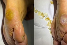 Bác sĩ mách cách chăm sóc và điều trị chai chân cho đúng