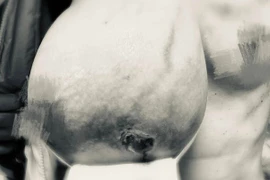 Cắt bỏ khối u vú nặng hơn 3kg cho người phụ nữ 49 tuổi